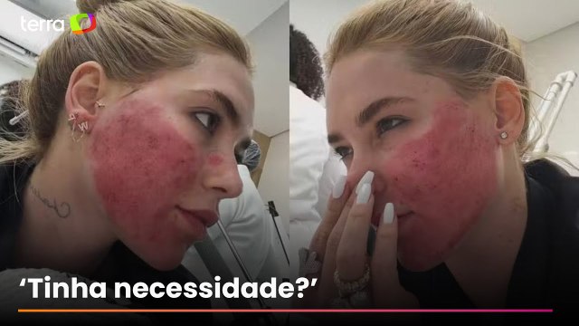 Virginia tranquiliza fãs após aparecer com rosto 'em carne viva' por procedimento estético