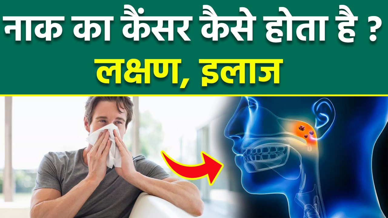 Symptoms Of Nasal Cancer: नाक का कैंसर कैसे होता है | Naak Ke Cancer ke Lakshan | Treatment In Hindi