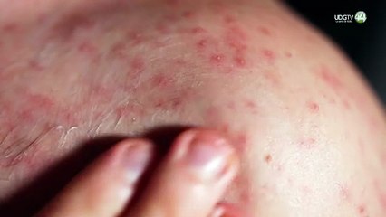 Jalisco a un paso de los 500 casos de sarampión; Arandas concentra el mayor brote