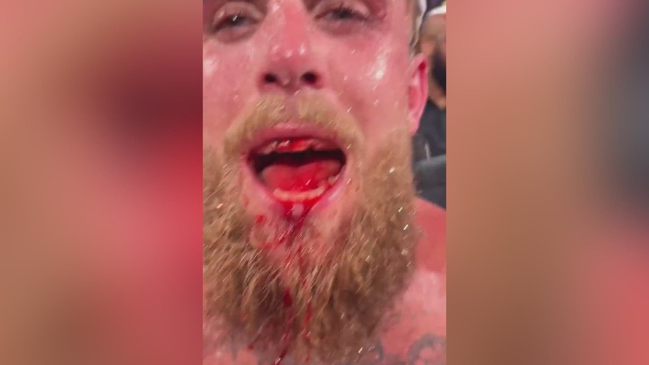 Anthony Joshua’s Brutal KO of Jake Paul: Broken Jaw and a Destroyed Face