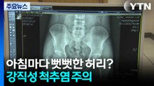 뻣뻣한 허리 방치하면 척추 위험...강직성 척추염 주의 / YTN