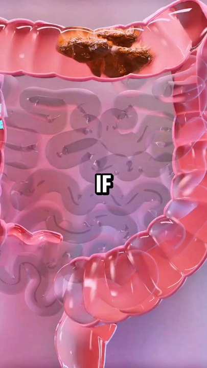 If you have constipation try these drinks every single day