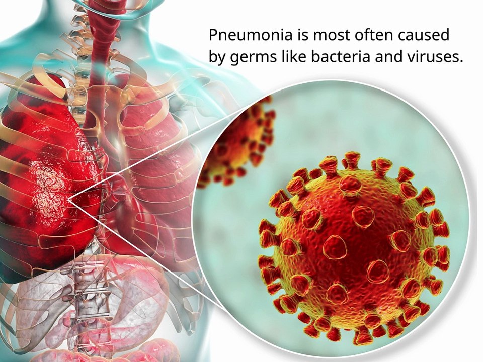 Pneumonia Prevention Guide: Protecting Your Lungs in the Modern World