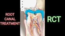 RCT - ROOT CANAL TREATMENT