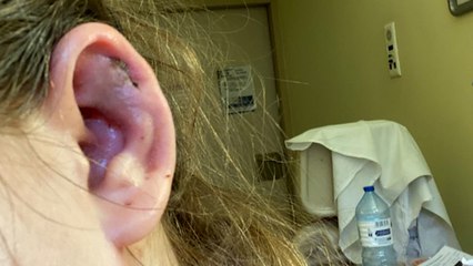 « J’ai perdu un bout d'oreille » : les dangers méconnus des piercings au cartilage