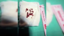 Estetik ameliyatta şaşırtan olay, burundan taş çıktı
