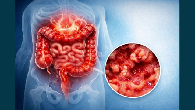 Colite ulcerosa, nuove opzioni terapeutiche