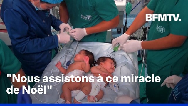 Pérou: deux sœurs siamoises séparées avec succès lors d'une opération complexe