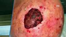 Dünyada 3’üncü kez rastlandı: Saçlı derideki nadir tümör Sakarya’da tedavi edildi