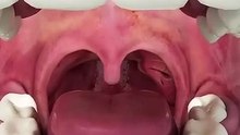 How Tonsils Stones are formed