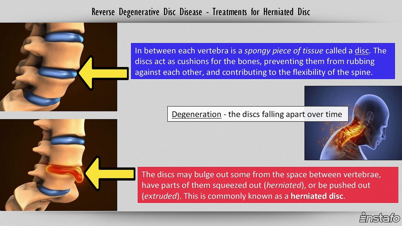 Reverse Degenerative Disc Disease - Treatments for Herniated Disc