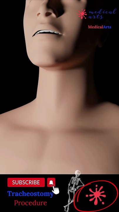 Tracheostomy_procedure_3D