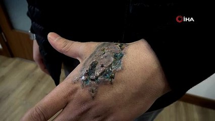 Dövme Sildirme Seansı Kabusa Döndü: Elinde İkinci Derece Yanık Oluştu!