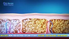 Hiểu đúng về công nghệ đông hủy mỡ không "dao kéo”