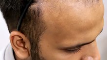 Witness another successful hair transplant journey at Zeeva Clinic, Ahmedabad