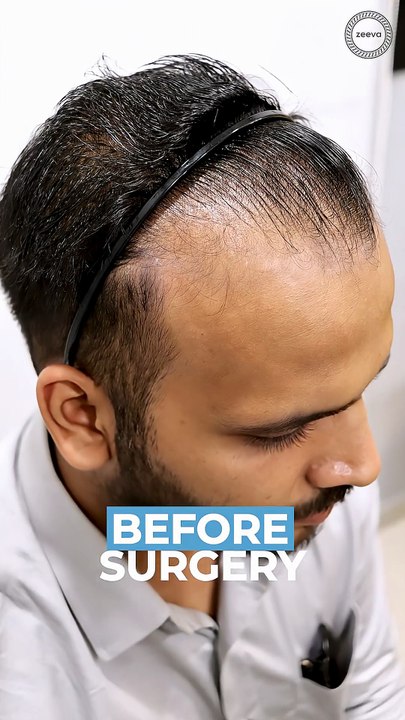 Witness another successful hair transplant journey at Zeeva Clinic, Ahmedabad