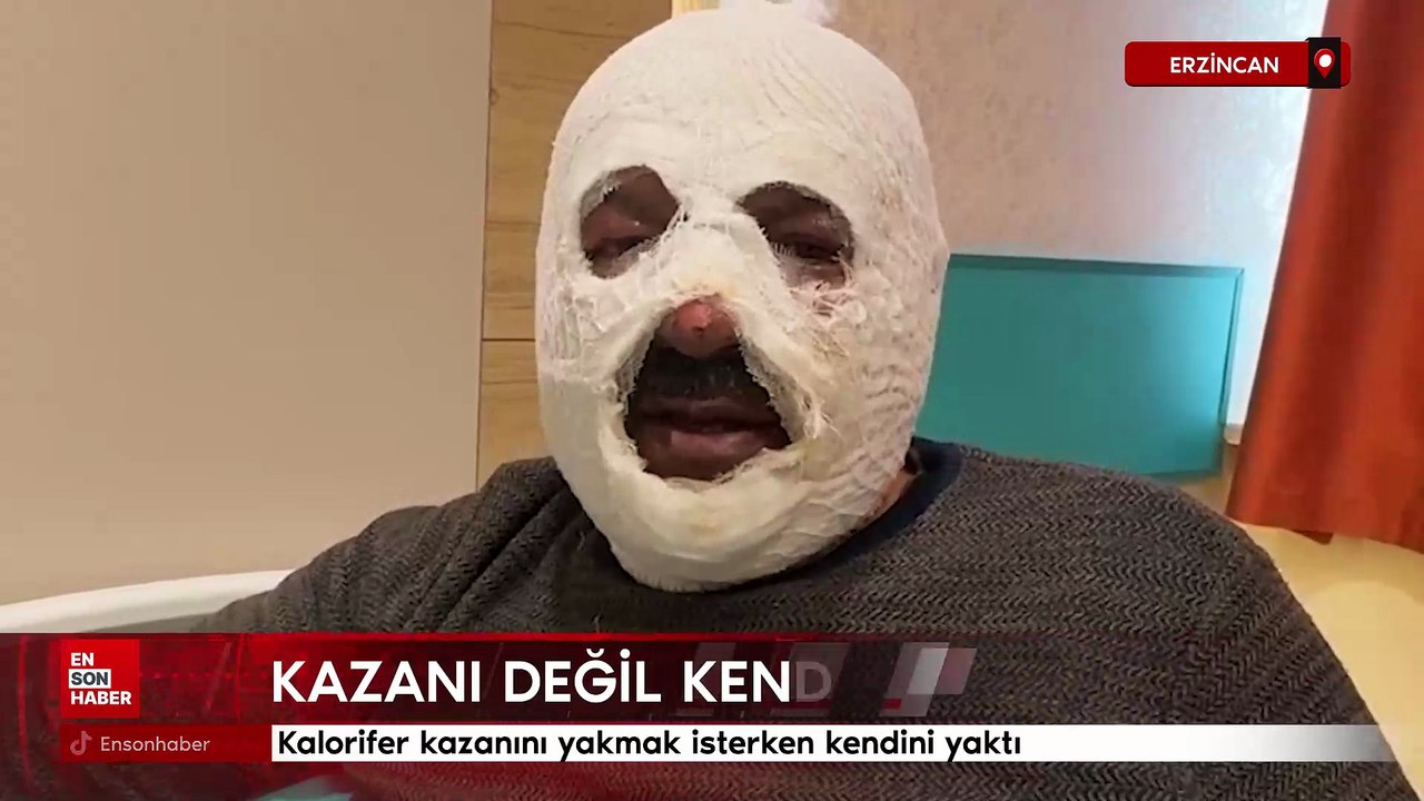 Erzincan'da kalorifer kazanını yakmak isterken kendini yaktı