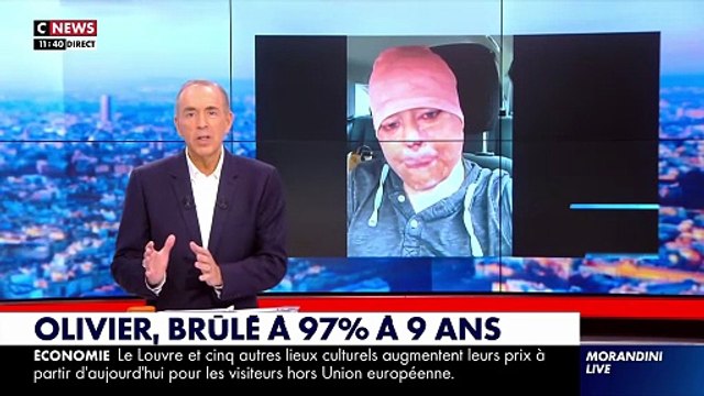 Olivier, brûlé à 97% à l’âge de 9 ans, témoigne dans « Morandini Live » sur CNews