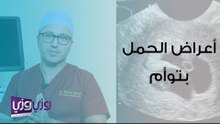 أعراض الحمل بتوأم ومخاطره