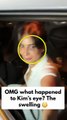 OMG, what happened to Kim Sharma’s eye? The under-eye swelling grabs attention