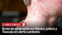 Sarampión reaparece en México: Jalisco segundo lugar nacional en contagios