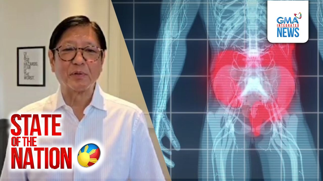 Diverticulitis na iniinda ni PBBM, namamana o dahil sa mga kinakain, ayon sa eksperto | SONA