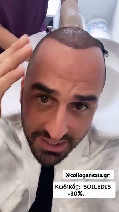 Ο Άρης Σοϊλέδης έκανε μεταμόσχευση μαλλιών