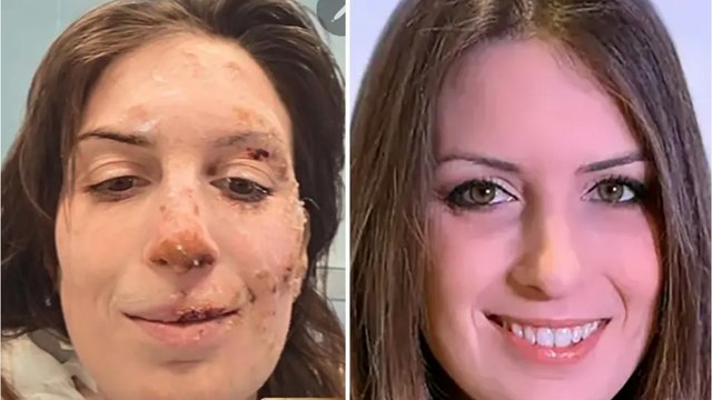 Une rescapée de Crans-Montana dévoile ses brûlures