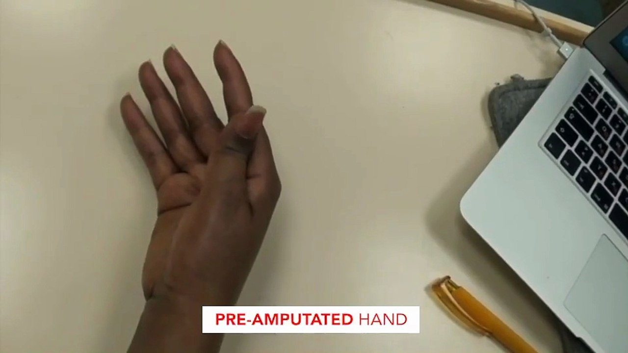 Stable cortical body maps before and after arm amputation