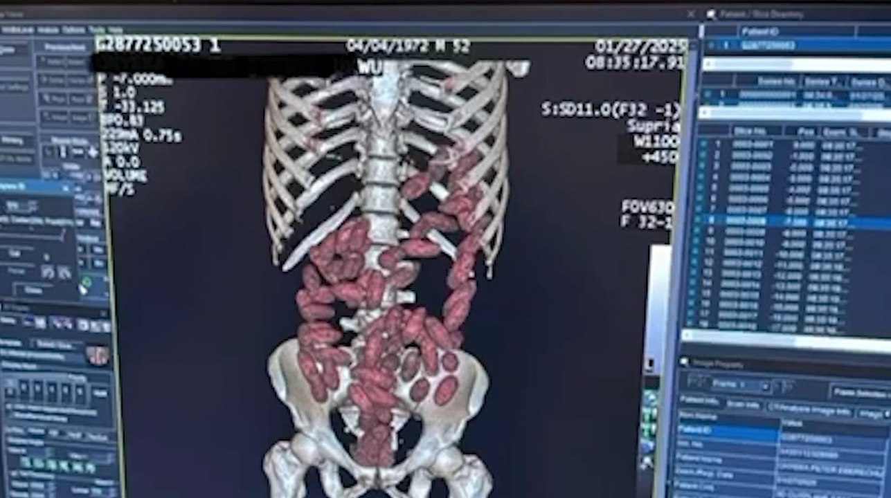 2025’te İstanbul Havalimanı’nda ‘yutucu’ kuryelerden 29,7 kilo uyuşturucu ele geçirildi