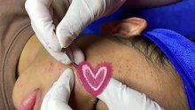 Extracción de acné muy satisfactoria | Satisfying Acne Extraction