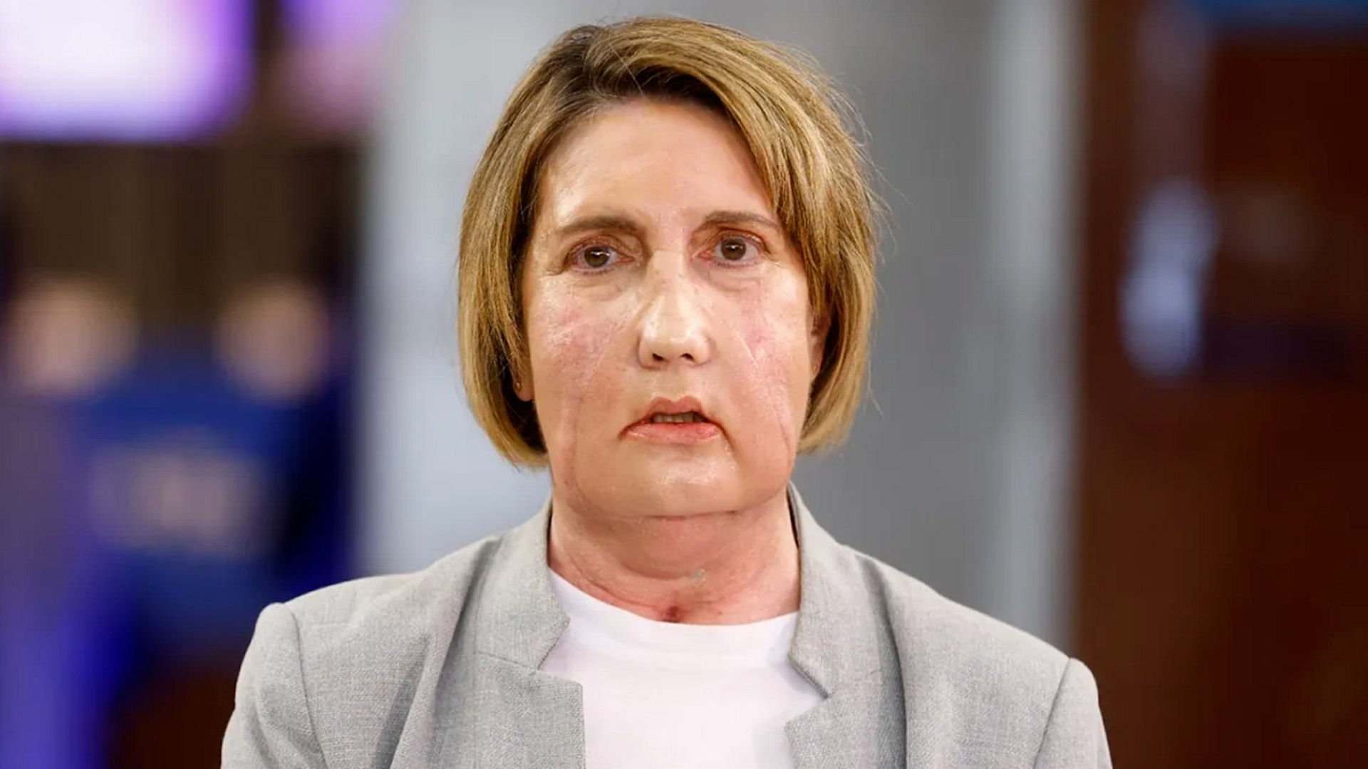 El Hospital Vall d'Hebron de Barcelona ha marcado un precedente hist�rico en la medicina global al completar con �xito el primer trasplante de cara realizado en el mundo con una donaci�n procedente de una paciente que falleci� por eutanasia. Este hito, anunciado este lunes por los directivos del centro hospitalario, representa un avance significativo tanto en la t�cnica quir�rgica como en la gesti�n de donantes en circunstancias complejas.