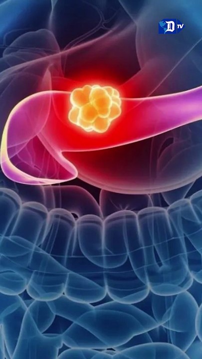 Científicos españoles descubren varios genes que abren la puerta a un diagnóstico más temprano del cáncer de páncreas | La buena noticia