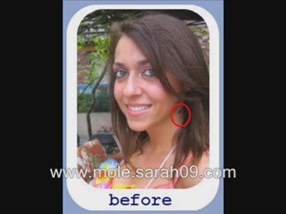 Mole Removal - Natural Mole Removal - Skin Mole Removal