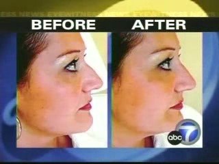 Non-Surgical Rhinoplasty