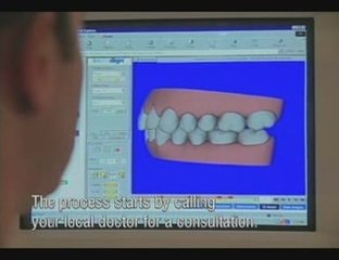 Invisible braces from Invisalign