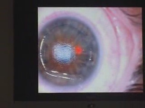 Lasik Femto 100% laser myopie Dr Chemla Centre Vision Laser