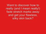Remove unqanted Stretch marks Fast - Natural Medical ...