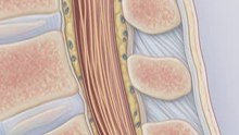 Procedimiento de Punción Lumbar. Fuente: NEJM.org