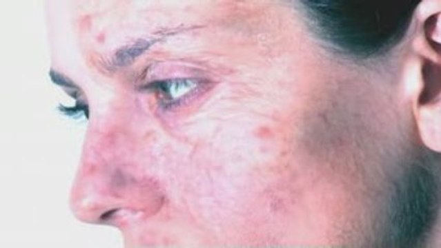 Skincare - Sk:n Awareness Advert