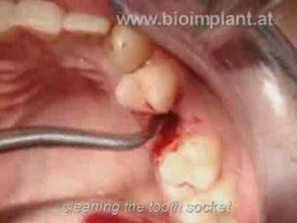 WORLD'S FIRST:IMMEDIATE ROOT-ANALOG ZIRCONIA DENTAL IMPLANT