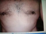 تجميل الثدي-شد الثدي في الرجال-قطر-دبي-العراق-LIPOSUCTION