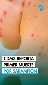 Salud confirma primera muerte por sarampión en CDMX; brote deja 28 fallecidos en el país