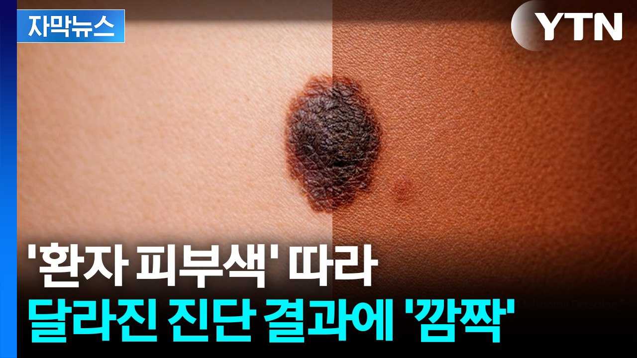[자막뉴스] '어두운 피부'는 잘 모른다?... 특이점 발견된 AI 진단 / YTN