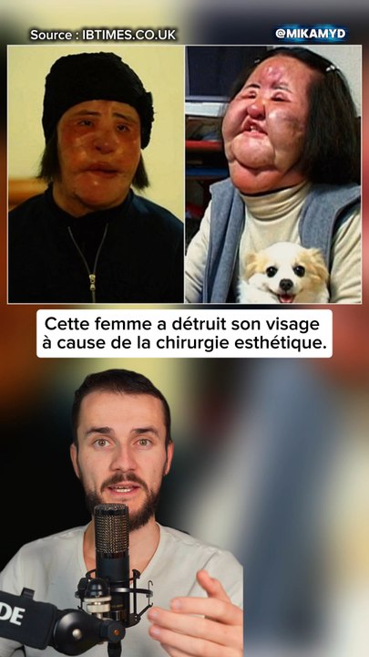 Cette femme a détruit son visage à cause de la chirurgie esthétique.