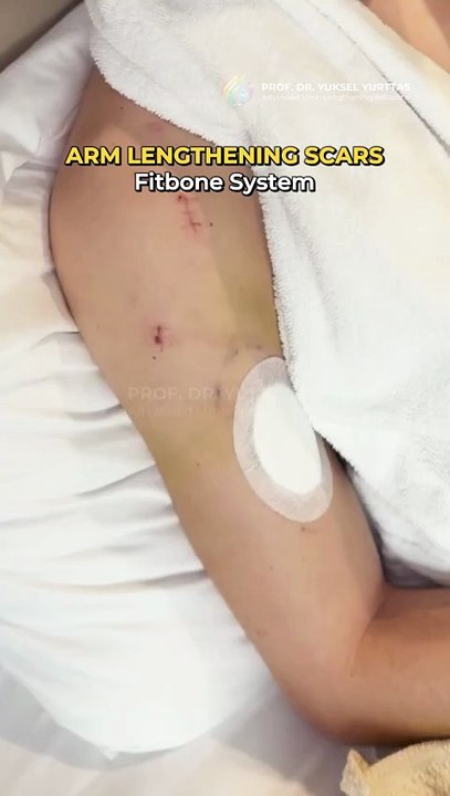 Arm Lengthening Surgery with Fitbone - Scars | Prof. Dr. Yuksel Yurttas