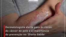 Dermatologista alerta para os riscos do câncer de pele e a importância da prevenção no ‘Diário Saúde’