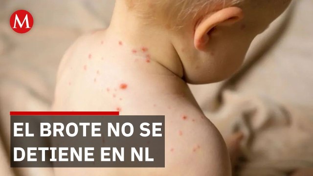 Nuevo León registra 35 casos de sarampión; México supera los 11 mil contagios