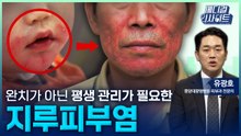 [메디컬 인사이트 125회] 평생 관리가 필요한 '지루피부염' / YTN