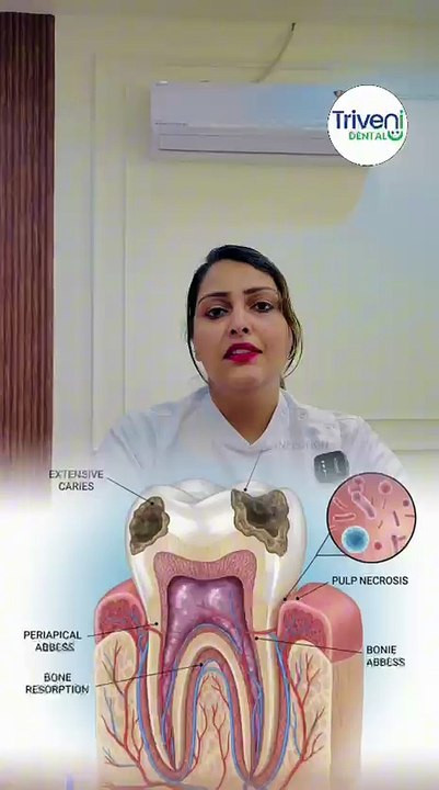 When you need Tooth Extraction | Tooth Removal | Triveni Dental